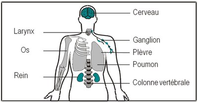 TB_extrapulmonaire.jpg